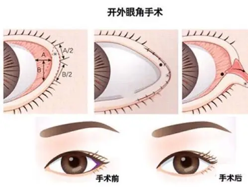 什么是内眦赘皮?