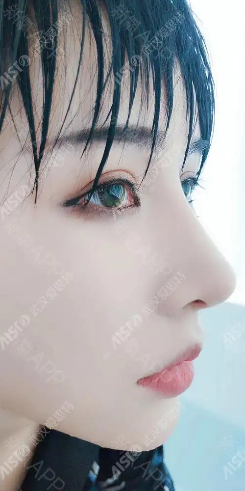 鼻部多项好不好_效果图_宝喇叭喇叭鼻部多项术后第188天_新氧美容整形