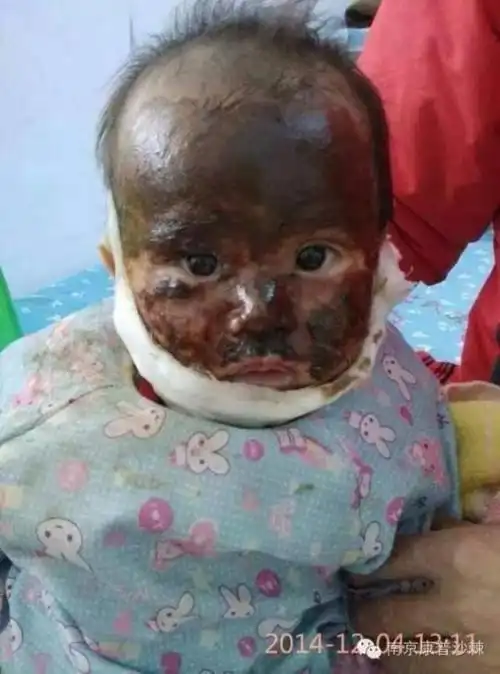 1岁小孩脸部80%被严重烫伤,用了很常见的这个东西,半年不到脸完全好了