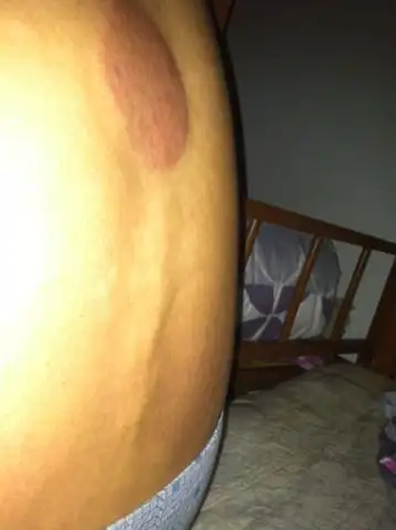 脊柱后凸能治好吗? 弯腰的时候脊柱凸出