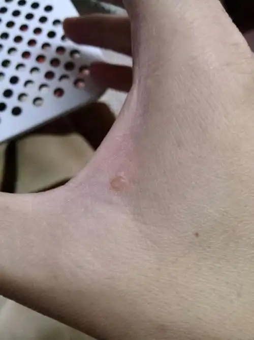 突然发现手上长个透明小疙瘩有点像小水珠?