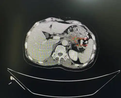 母亲查出胰腺癌晚期,女儿 隐瞒 病情与医生合力助她抗癌