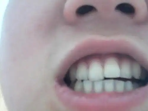 14岁女生,有一颗门牙往外凸,妈妈说让我带牙套,可我不想带,有什么好的