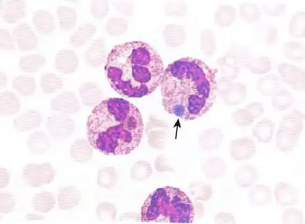 ④杜勒小体(dohel体)
