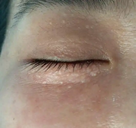 汗管瘤的最佳去除方法电解治疗