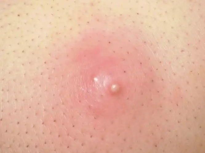 粉瘤挤出来是啥样图片