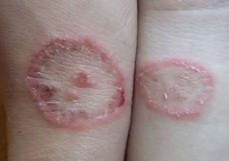 体癣是一种传染病_体癣知识_大成皮肤网