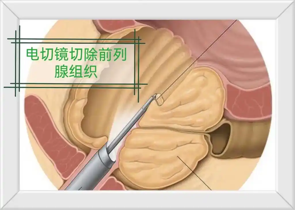 医学科普 9292前列腺增生或者做了手术后排尿有哪些改变呢 - 抖