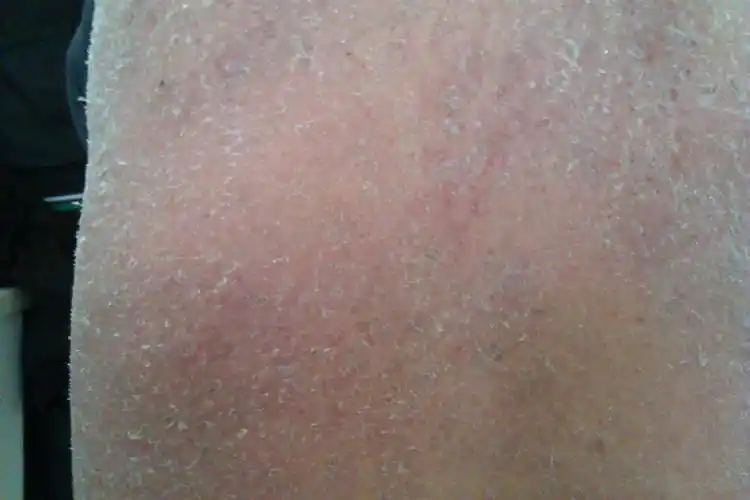 一名红皮病患者的开心笑脸的启示