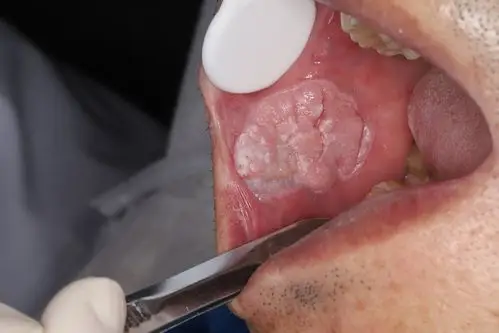 口腔癌诊断2例! - 好大夫在线