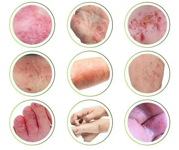 佩服!湿疹的图片"孕妈咪网"-第2张图片-新余博客