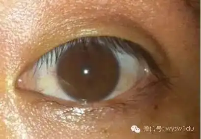 眼白为什么不白了?眼白出现这个颜色,你要小心了