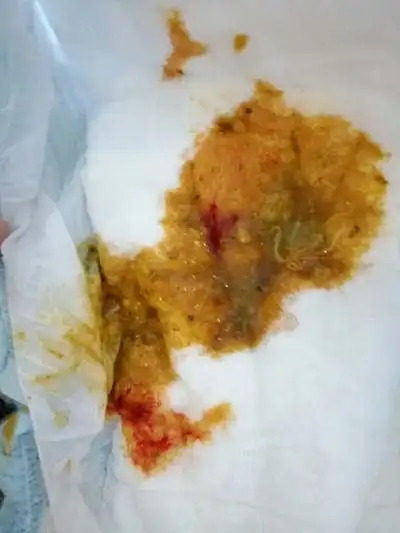 婴儿肠炎大便图片47