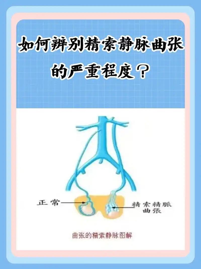 关注我分享更多健康知识 #成都 如何辨别精索静脉曲张的严重 - 抖音