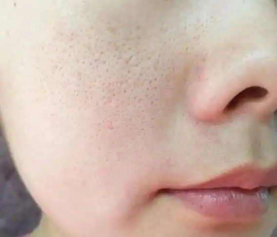 u牌想要改善毛孔粗大首先要知道毛孔粗大的原因是什么