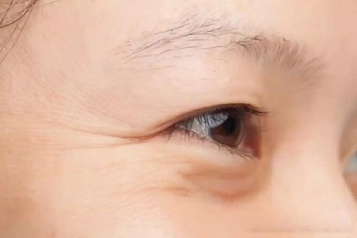 有些人在眼角用肉毒毒素注射鱼尾纹之后,发现外面的皱纹是减少了