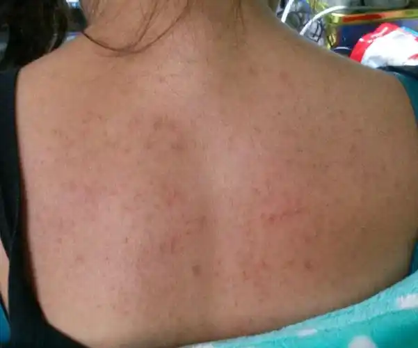 背上密密麻麻的小痘痘全是痘印怎么办,我今年20岁