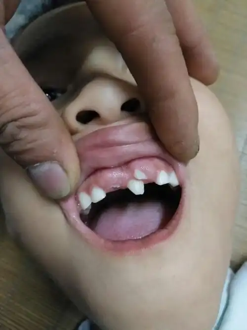 孩子的牙长这样怎么办,7周岁