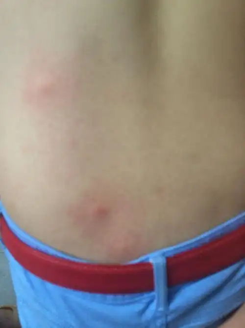 今天身上长这样的痘痘,都在腰上很痒,请问是什么症状?