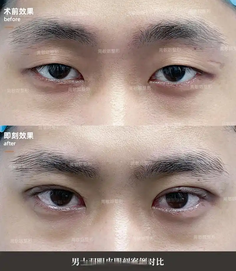 男士双眼皮案例分享 男生的双眼皮做法跟女生不同,弧度不宜夸张,宽度