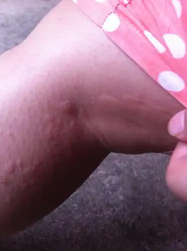 问:昨天晚上身上起了很多像蚊子一样咬的小包,很痒,洗了艾叶水,好了一