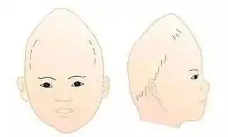 狭颅症脊柱裂胎宝宝比实际孕周小近一个月原来系统大排畸真的这么重要