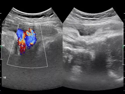 超声诊断脐带缠绕