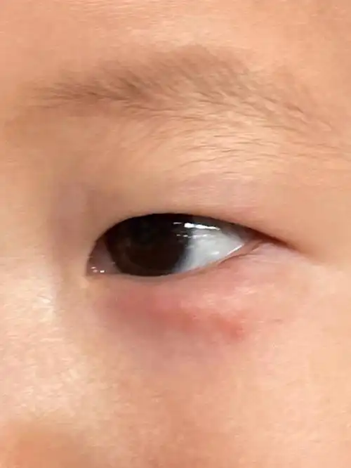 宝宝眼角长了小疙瘩是为啥