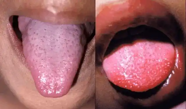 左图为"草莓舌",右图为"杨梅舌",国外叫做"白草梅舌"和"红草莓舌",更