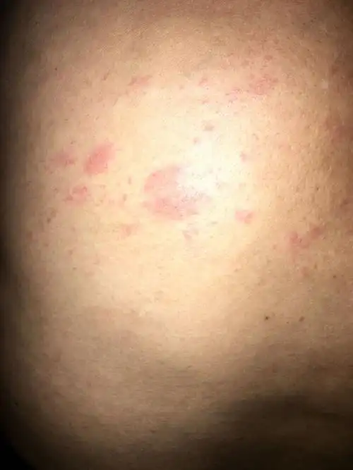 5条回答 皮肤过敏,来点无极膏.