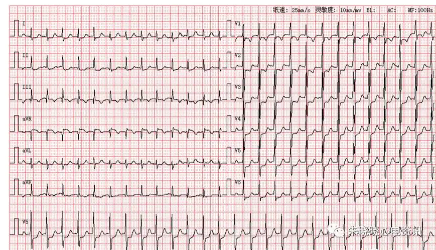 常见的室性心律失常心电图