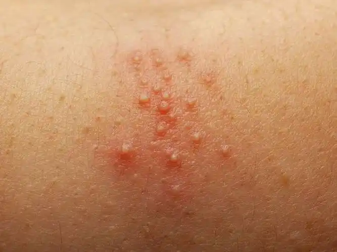 教你一分钟辨别9种宝宝常见皮肤病!建议收藏.