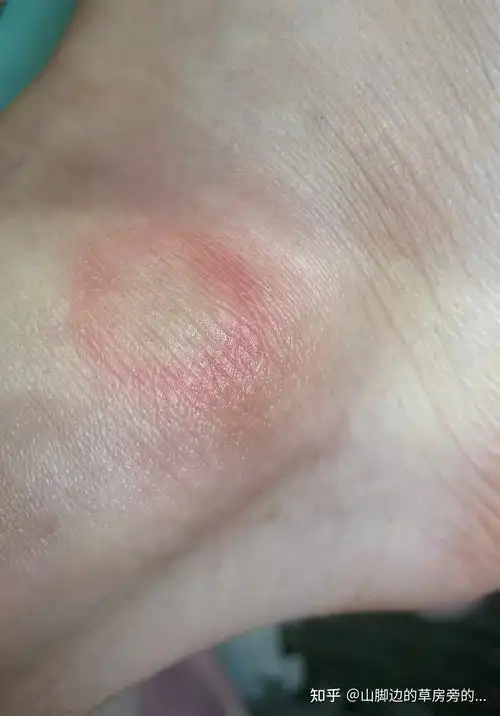 热水袋低温烫伤