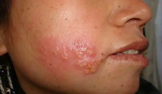 淋病还有潜伏期是怎么回事