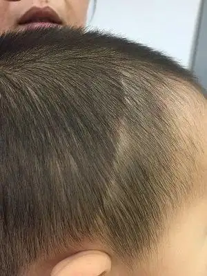 颅缝早闭——治疗篇_狭颅症_狭颅症治疗方式 - 好大夫在线