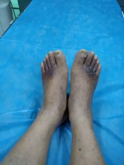 糖尿病病人,下肢疼痛,溃疡