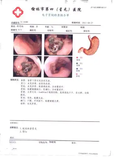 顽症不再是顽症仅以一例胃癌患者的电子胃镜镜象康复过程对比分析