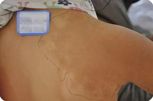 济南胎记血管瘤医院收费怎么样:贝克痣会不会遗传?