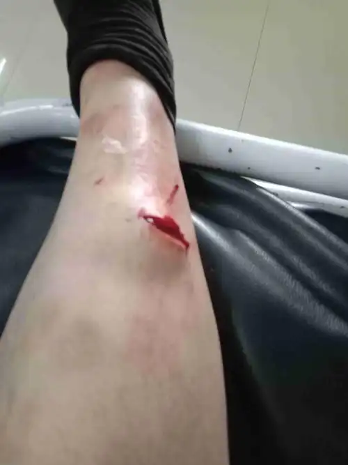 建筑农民工右小腿受伤缝了五针怎么索赔