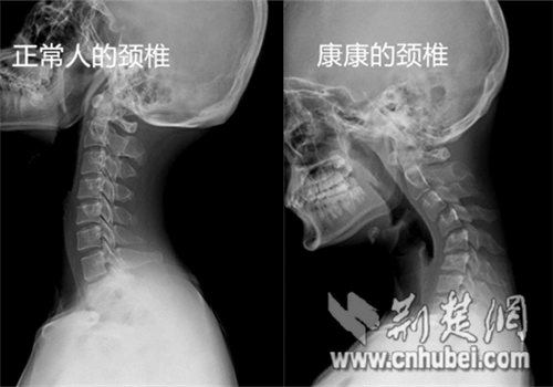 16岁男孩颈椎反弓近45低头玩手机成最大祸根