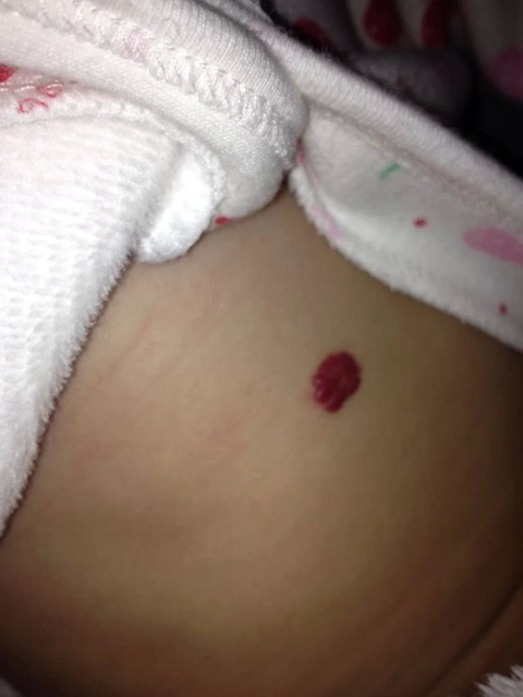 宝宝后背长个血管瘤,在上海激光三次了花了一万块了,这两天发现还有一