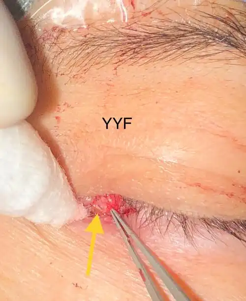 下泪小点旁黄色囊肿样病变的手术治疗和泪道吻合& 小 ,但绝不意味着