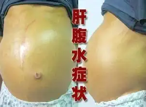中医治疗肝腹水
