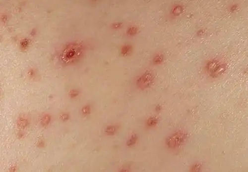 艾滋病初期症状图片