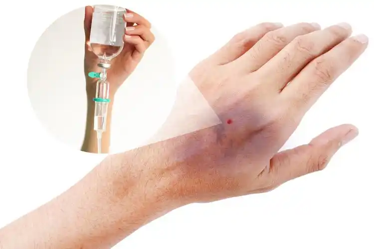 输液导致手背淤青,是由于在手背处打针的地方出血,或者是拔针的时候