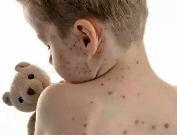 开学季,请注意手足口病的传染