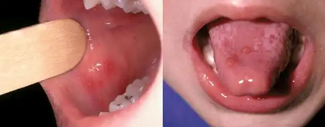 他表示,手足口病的潜伏期多为2-10天,平均3-5天,在发病早期,患儿有