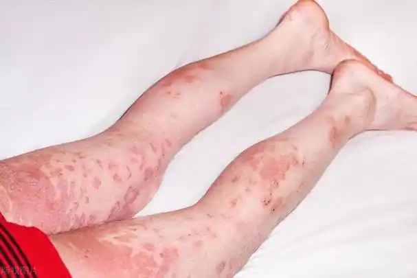 别不重视|症状|高血糖|低血糖|糖尿病患者_网易订阅