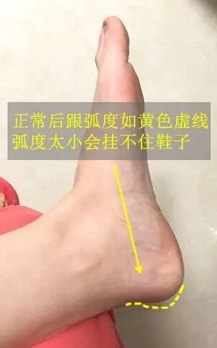 没有脚后跟这辈子就只能告别单鞋了吗00补充了脚后跟图又加了一张