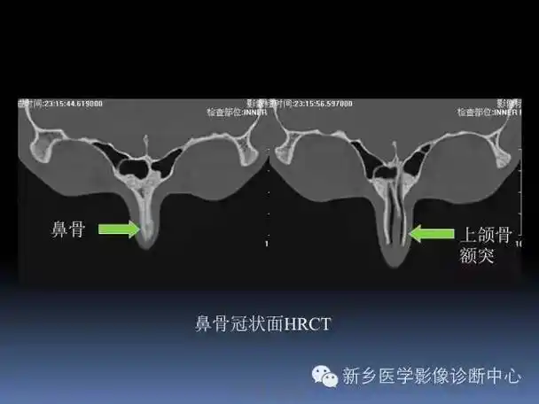 写鼻骨骨折ct报告,一定要了解的解剖